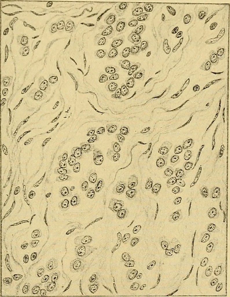 An illustration from A text-book of pathology for students of medicine / by J. George Adami and John McCrae ; illustrated with 304 engravings and 11 colored plates., 1912, leaf 153