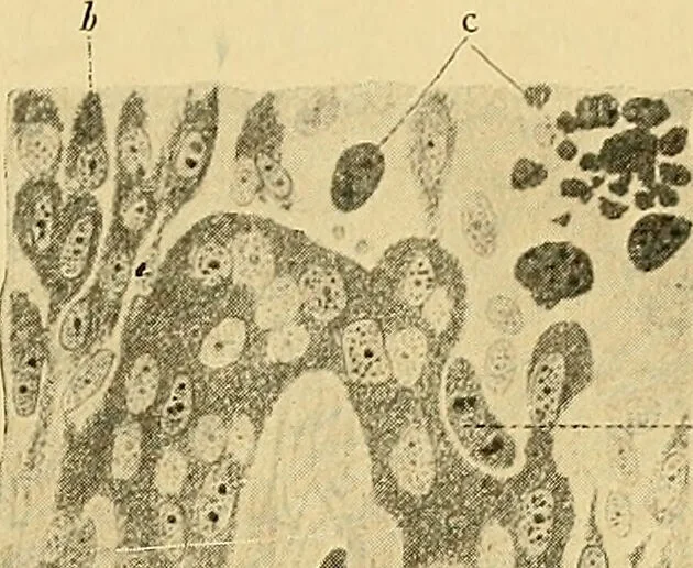 An illustration from A text-book of pathology for students of medicine / by J. George Adami and John McCrae ; illustrated with 304 engravings and 11 colored plates., 1912, leaf 225