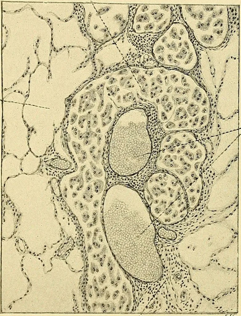 An illustration from A text-book of pathology for students of medicine / by J. George Adami and John McCrae ; illustrated with 304 engravings and 11 colored plates., 1912, leaf 230