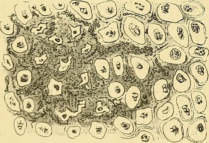 An illustration from A text-book of pathology for students of medicine / by J. George Adami and John McCrae ; illustrated with 304 engravings and 11 colored plates., 1912, leaf 246