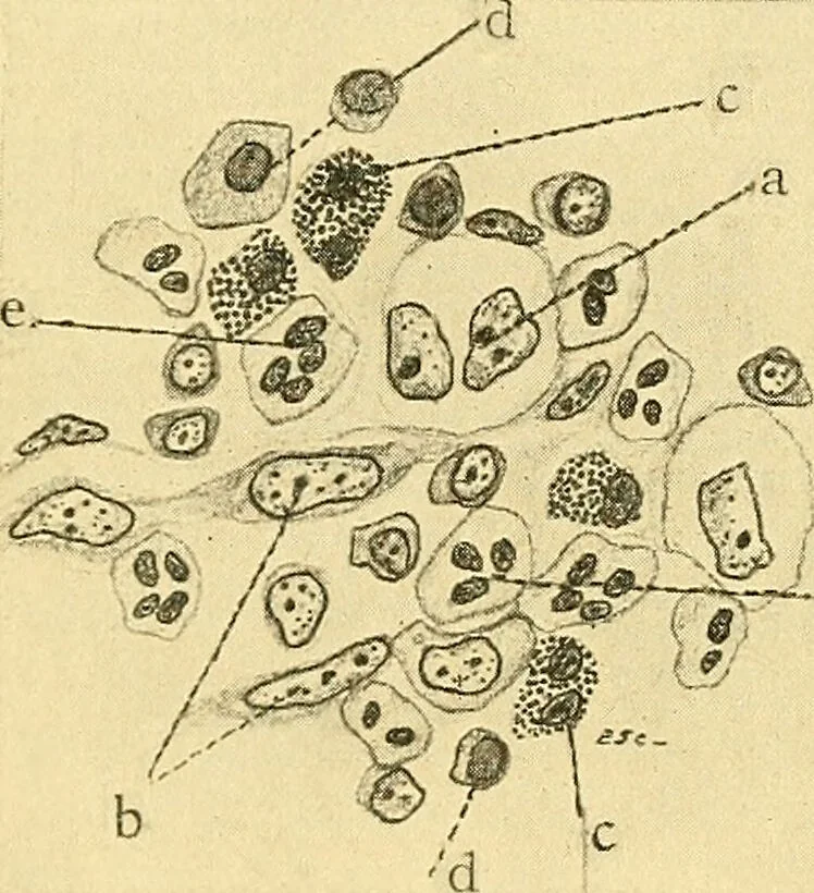 An illustration from A text-book of pathology for students of medicine / by J. George Adami and John McCrae ; illustrated with 304 engravings and 11 colored plates., 1912, leaf 252