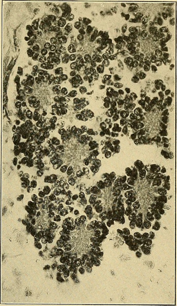 An illustration from A text-book of pathology for students of medicine / by J. George Adami and John McCrae ; illustrated with 304 engravings and 11 colored plates., 1912, leaf 257