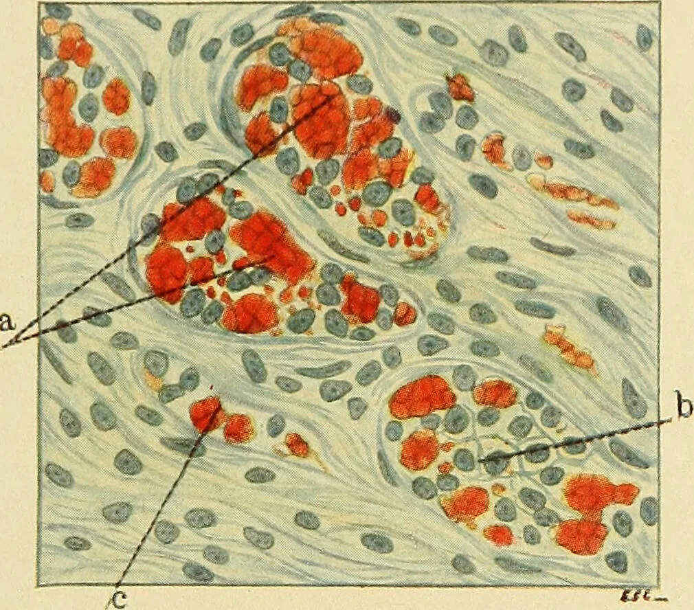 An illustration from A text-book of pathology for students of medicine / by J. George Adami and John McCrae ; illustrated with 304 engravings and 11 colored plates., 1912, leaf 279
