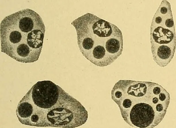 An illustration from A text-book of pathology for students of medicine / by J. George Adami and John McCrae ; illustrated with 304 engravings and 11 colored plates., 1912, leaf 281