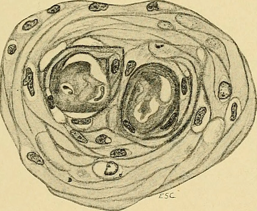 An illustration from A text-book of pathology for students of medicine / by J. George Adami and John McCrae ; illustrated with 304 engravings and 11 colored plates., 1912, leaf 283