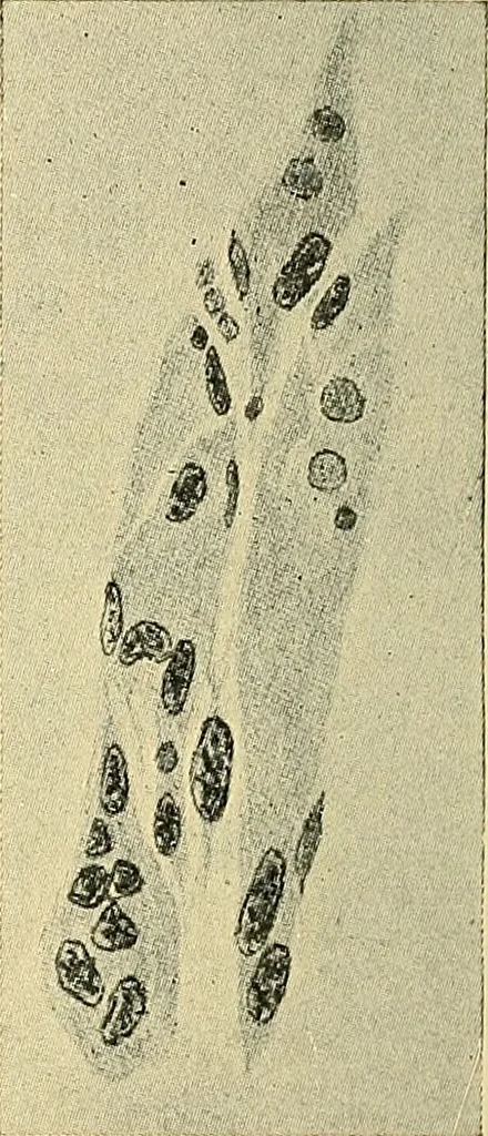 An illustration from A text-book of pathology for students of medicine / by J. George Adami and John McCrae ; illustrated with 304 engravings and 11 colored plates., 1912, leaf 290