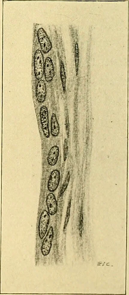 An illustration from A text-book of pathology for students of medicine / by J. George Adami and John McCrae ; illustrated with 304 engravings and 11 colored plates., 1912, leaf 302