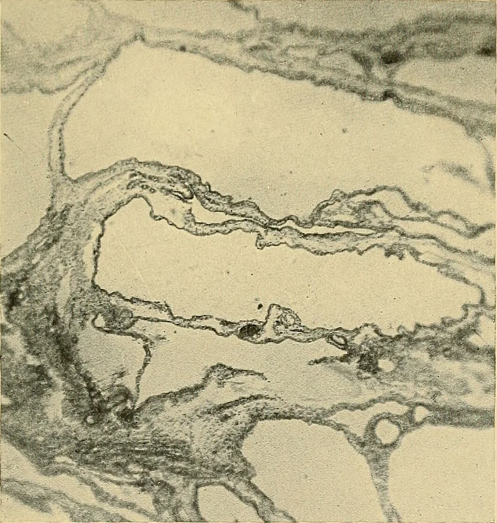 An illustration from A text-book of pathology for students of medicine / by J. George Adami and John McCrae ; illustrated with 304 engravings and 11 colored plates., 1912, leaf 305