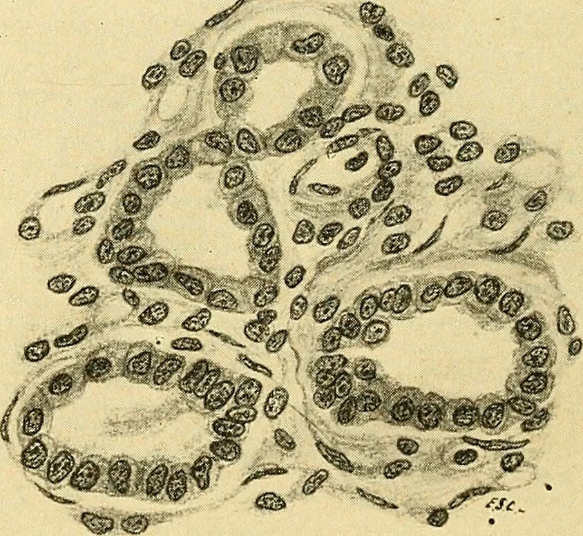 An illustration from A text-book of pathology for students of medicine / by J. George Adami and John McCrae ; illustrated with 304 engravings and 11 colored plates., 1912, leaf 316