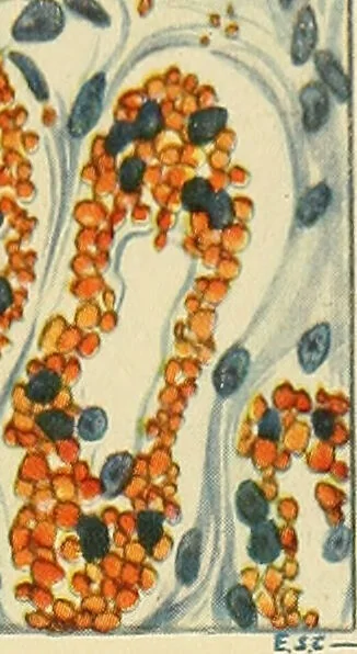 An illustration from A text-book of pathology for students of medicine / by J. George Adami and John McCrae ; illustrated with 304 engravings and 11 colored plates., 1912, leaf 323