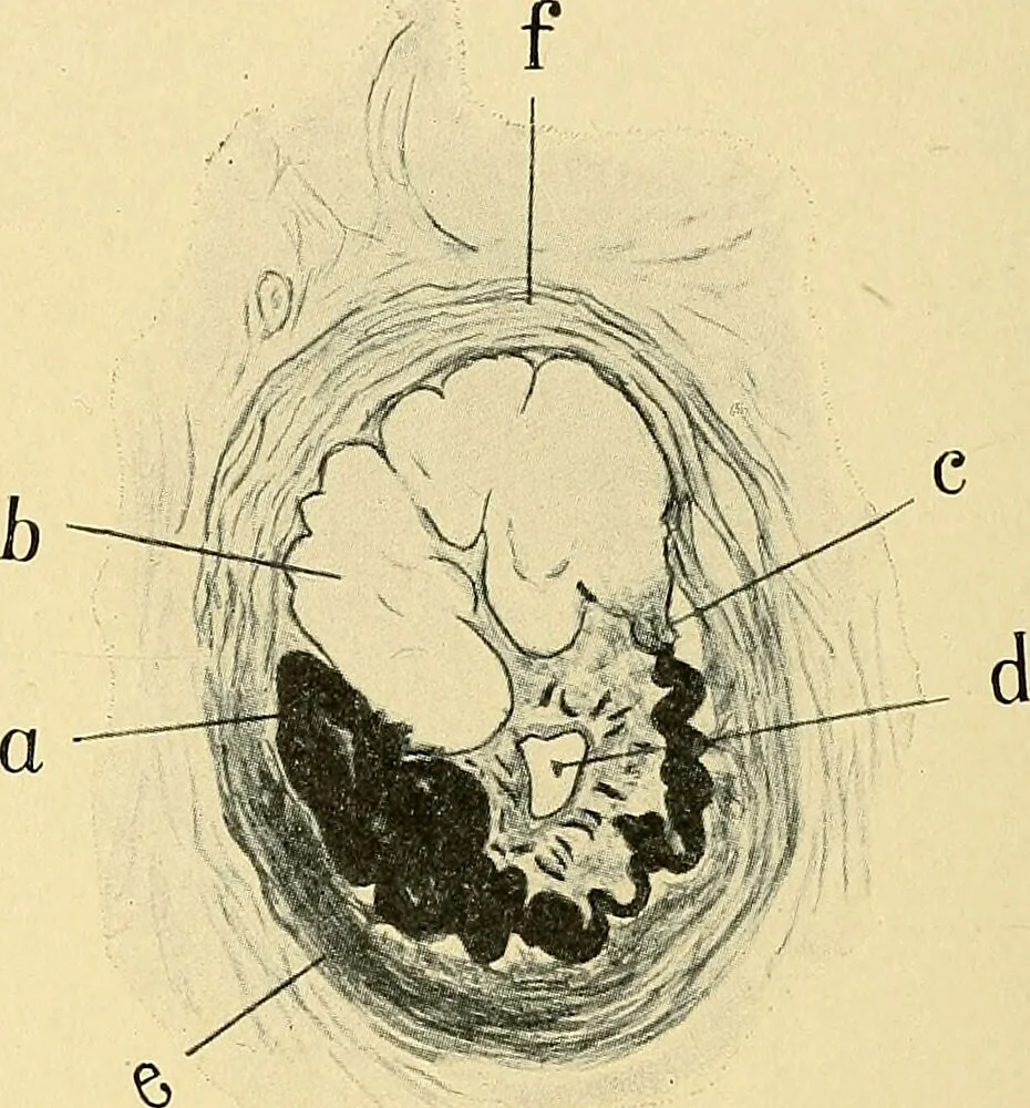 An illustration from A text-book of pathology for students of medicine / by J. George Adami and John McCrae ; illustrated with 304 engravings and 11 colored plates., 1912, leaf 328