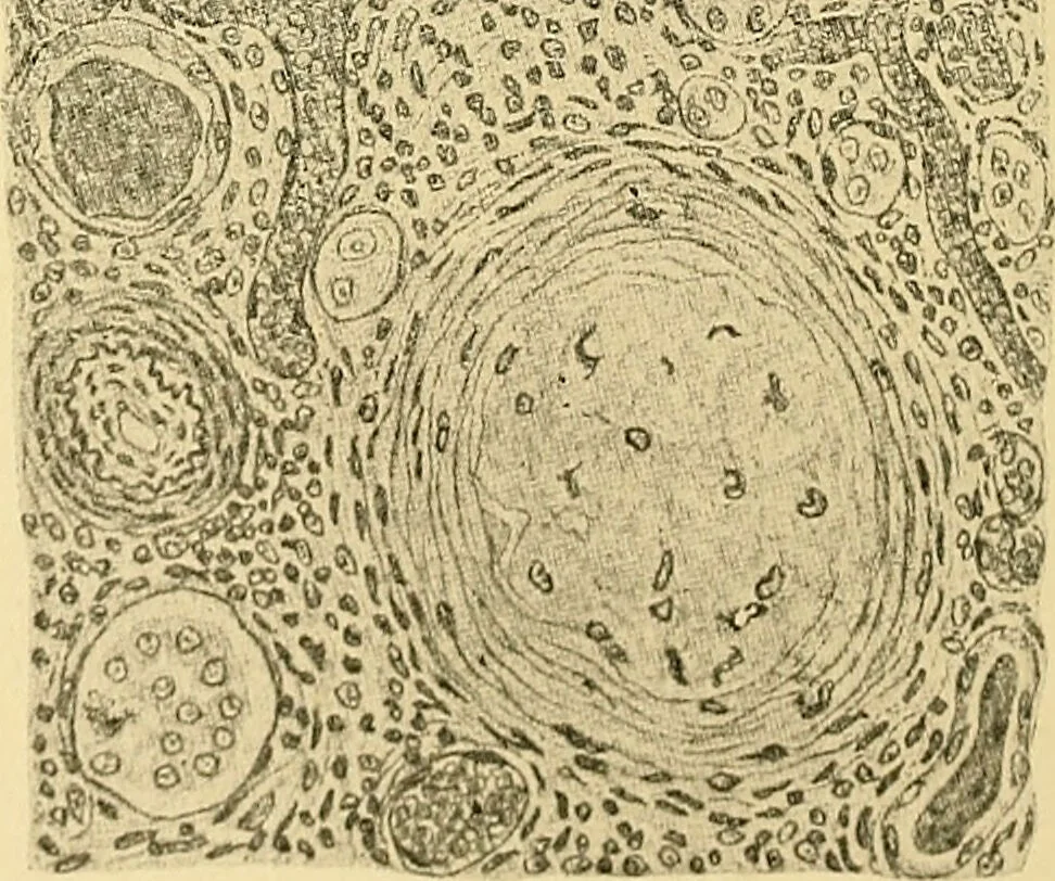 An illustration from A text-book of pathology for students of medicine / by J. George Adami and John McCrae ; illustrated with 304 engravings and 11 colored plates., 1912, leaf 328