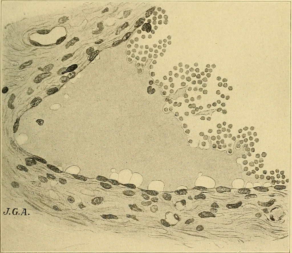 An illustration from A text-book of pathology for students of medicine / by J. George Adami and John McCrae ; illustrated with 304 engravings and 11 colored plates., 1912, leaf 329