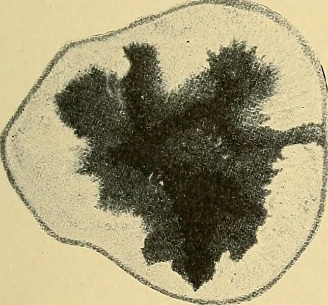 An illustration from A text-book of pathology for students of medicine / by J. George Adami and John McCrae ; illustrated with 304 engravings and 11 colored plates., 1912, leaf 337