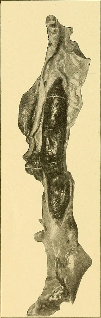 An illustration from A text-book of pathology for students of medicine / by J. George Adami and John McCrae ; illustrated with 304 engravings and 11 colored plates., 1912, leaf 368