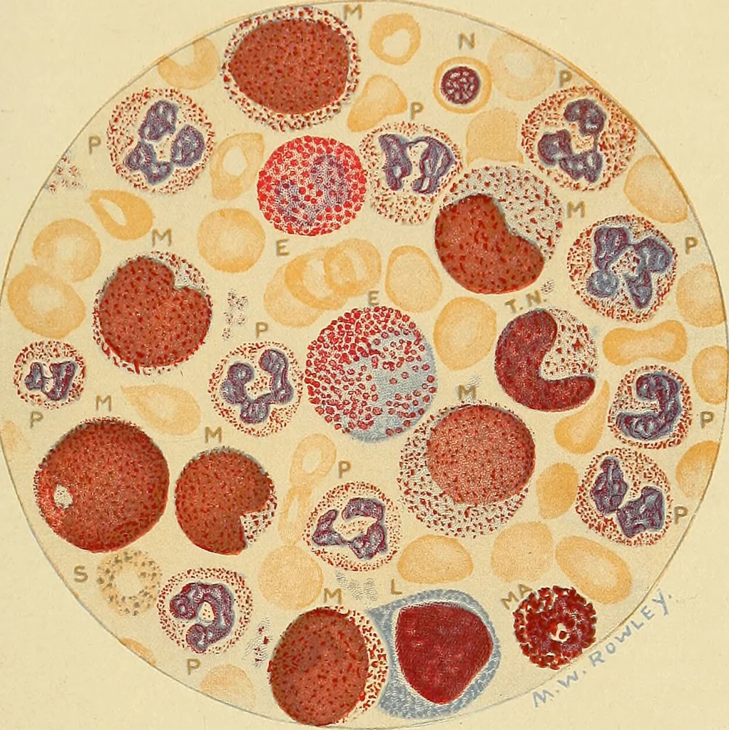 An illustration from A text-book of pathology for students of medicine / by J. George Adami and John McCrae ; illustrated with 304 engravings and 11 colored plates., 1912, leaf 383