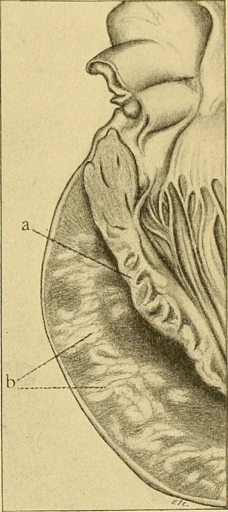 An illustration from A text-book of pathology for students of medicine / by J. George Adami and John McCrae ; illustrated with 304 engravings and 11 colored plates., 1912, leaf 413