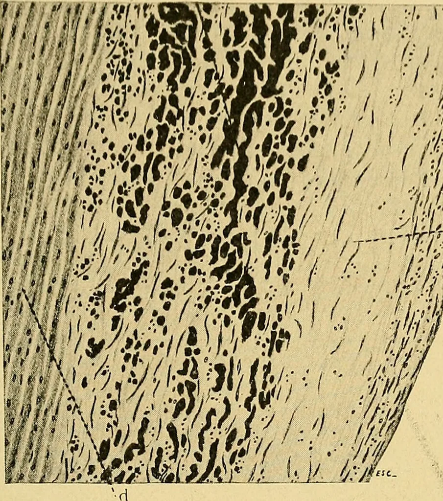 An illustration from A text-book of pathology for students of medicine / by J. George Adami and John McCrae ; illustrated with 304 engravings and 11 colored plates., 1912, leaf 425