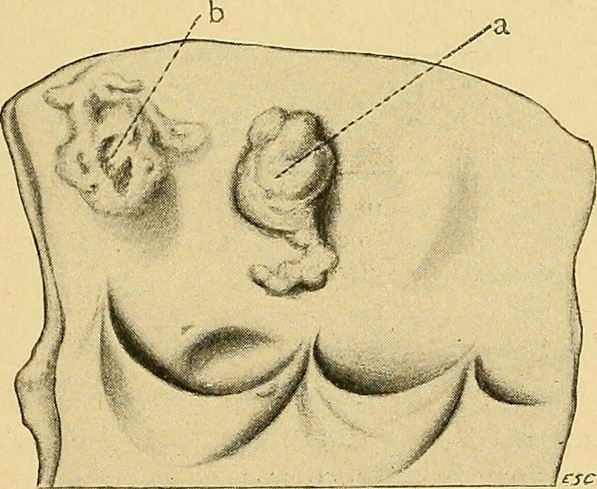 An illustration from A text-book of pathology for students of medicine / by J. George Adami and John McCrae ; illustrated with 304 engravings and 11 colored plates., 1912, leaf 425