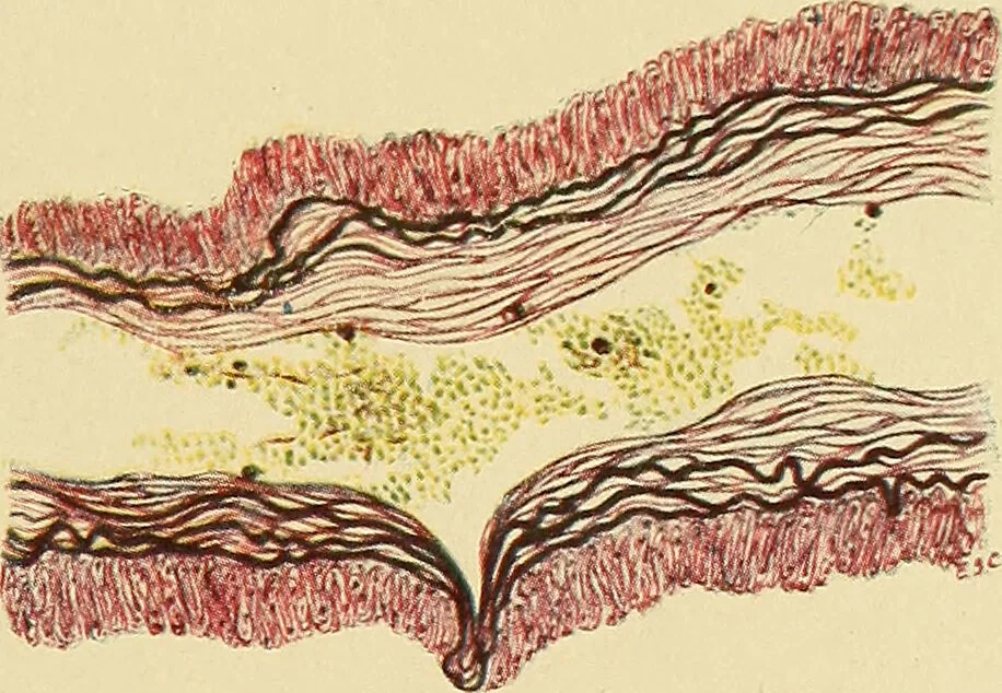 An illustration from A text-book of pathology for students of medicine / by J. George Adami and John McCrae ; illustrated with 304 engravings and 11 colored plates., 1912, leaf 429