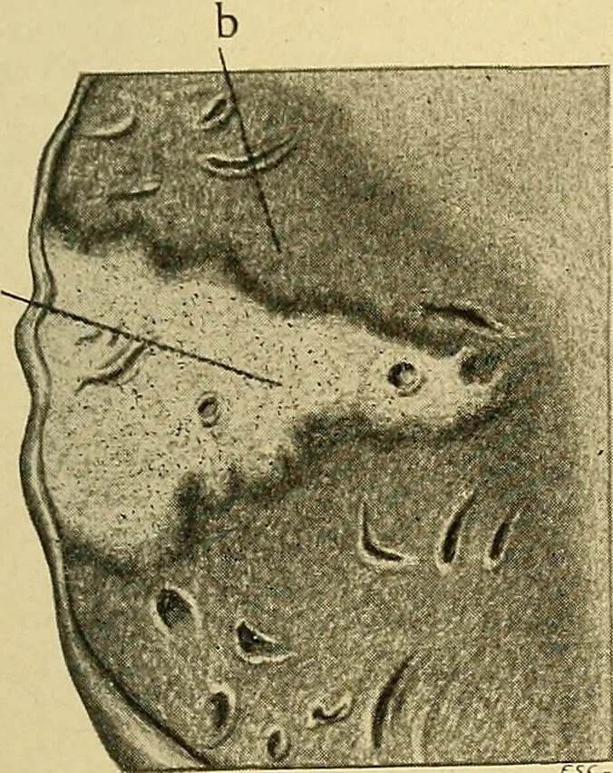 An illustration from A text-book of pathology for students of medicine / by J. George Adami and John McCrae ; illustrated with 304 engravings and 11 colored plates., 1912, leaf 441