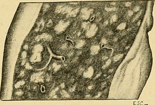 An illustration from A text-book of pathology for students of medicine / by J. George Adami and John McCrae ; illustrated with 304 engravings and 11 colored plates., 1912, leaf 441