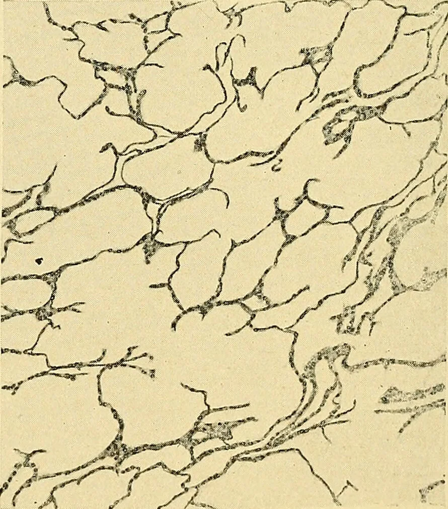 An illustration from A text-book of pathology for students of medicine / by J. George Adami and John McCrae ; illustrated with 304 engravings and 11 colored plates., 1912, leaf 456