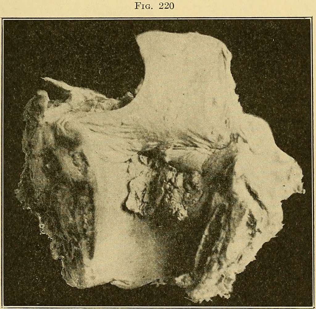 An illustration from A text-book of pathology for students of medicine / by J. George Adami and John McCrae ; illustrated with 304 engravings and 11 colored plates., 1912, leaf 467