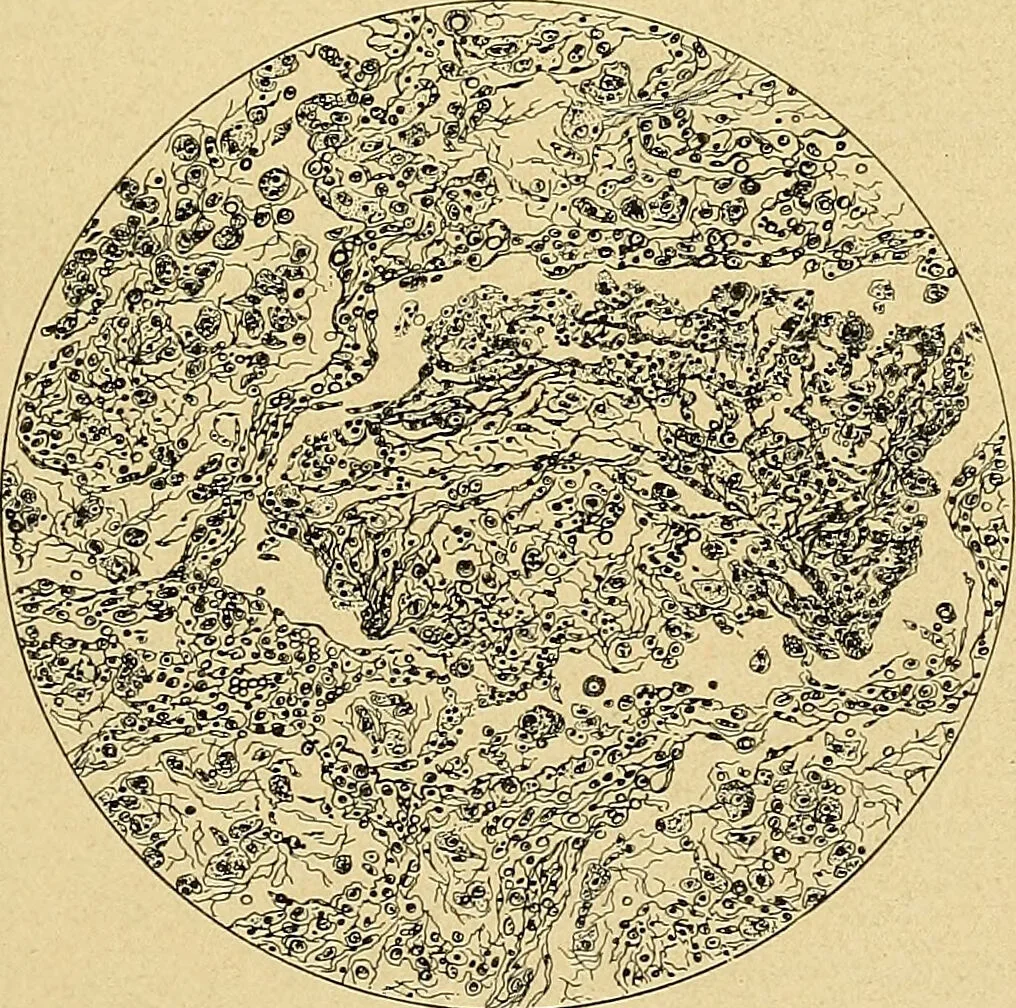 An illustration from A text-book of pathology for students of medicine / by J. George Adami and John McCrae ; illustrated with 304 engravings and 11 colored plates., 1912, leaf 477