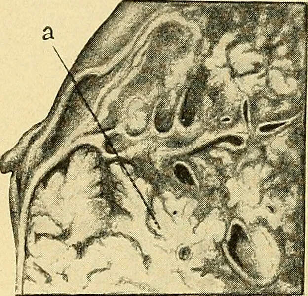 An illustration from A text-book of pathology for students of medicine / by J. George Adami and John McCrae ; illustrated with 304 engravings and 11 colored plates., 1912, leaf 488