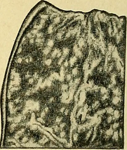An illustration from A text-book of pathology for students of medicine / by J. George Adami and John McCrae ; illustrated with 304 engravings and 11 colored plates., 1912, leaf 488