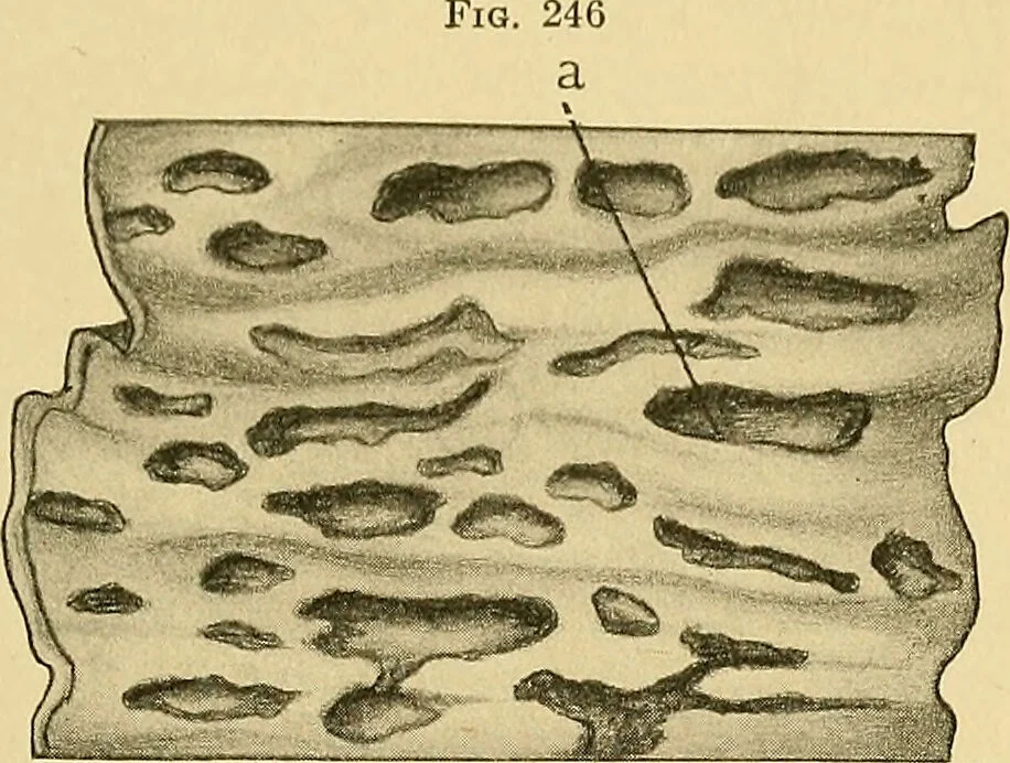 An illustration from A text-book of pathology for students of medicine / by J. George Adami and John McCrae ; illustrated with 304 engravings and 11 colored plates., 1912, leaf 583
