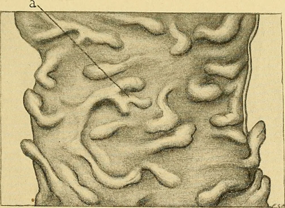An illustration from A text-book of pathology for students of medicine / by J. George Adami and John McCrae ; illustrated with 304 engravings and 11 colored plates., 1912, leaf 583