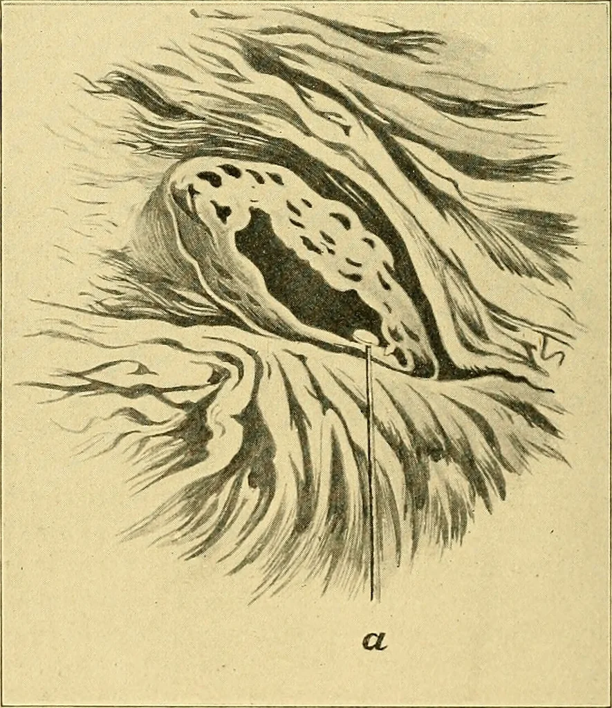 An illustration from A text-book of pathology for students of medicine / by J. George Adami and John McCrae ; illustrated with 304 engravings and 11 colored plates., 1912, leaf 588