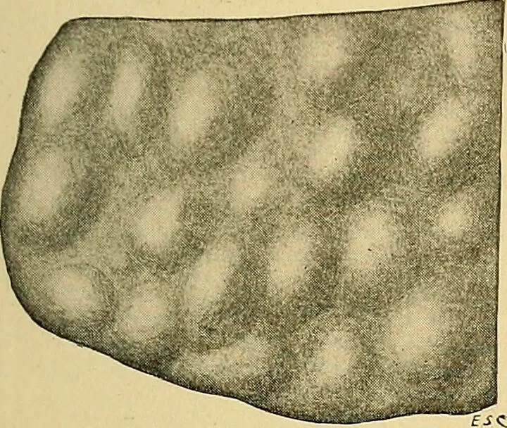 An illustration from A text-book of pathology for students of medicine / by J. George Adami and John McCrae ; illustrated with 304 engravings and 11 colored plates., 1912, leaf 601