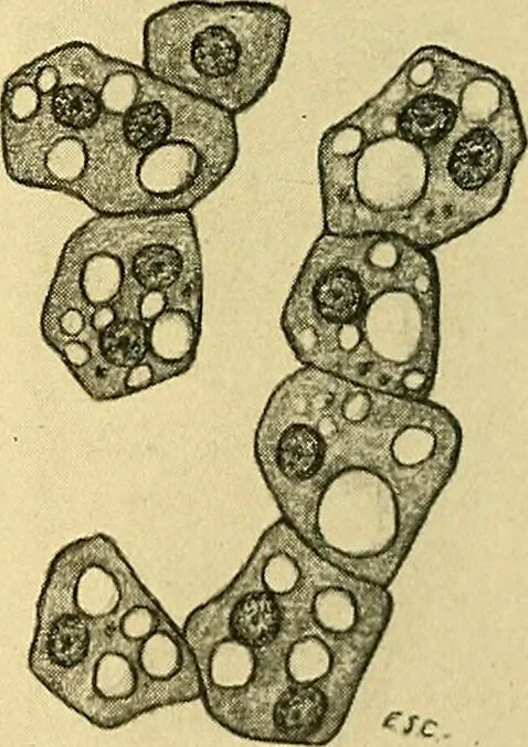An illustration from A text-book of pathology for students of medicine / by J. George Adami and John McCrae ; illustrated with 304 engravings and 11 colored plates., 1912, leaf 608