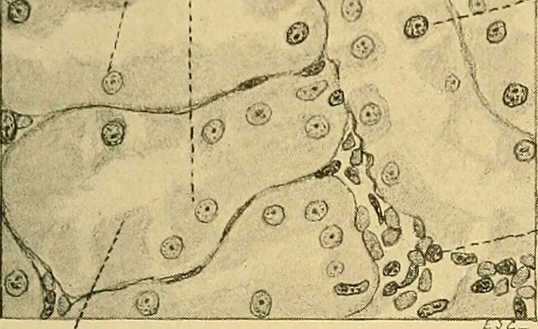 An illustration from A text-book of pathology for students of medicine / by J. George Adami and John McCrae ; illustrated with 304 engravings and 11 colored plates., 1912, leaf 635