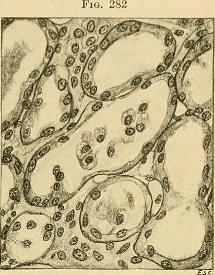 An illustration from A text-book of pathology for students of medicine / by J. George Adami and John McCrae ; illustrated with 304 engravings and 11 colored plates., 1912, leaf 637