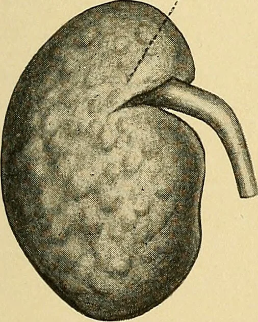 An illustration from A text-book of pathology for students of medicine / by J. George Adami and John McCrae ; illustrated with 304 engravings and 11 colored plates., 1912, leaf 637