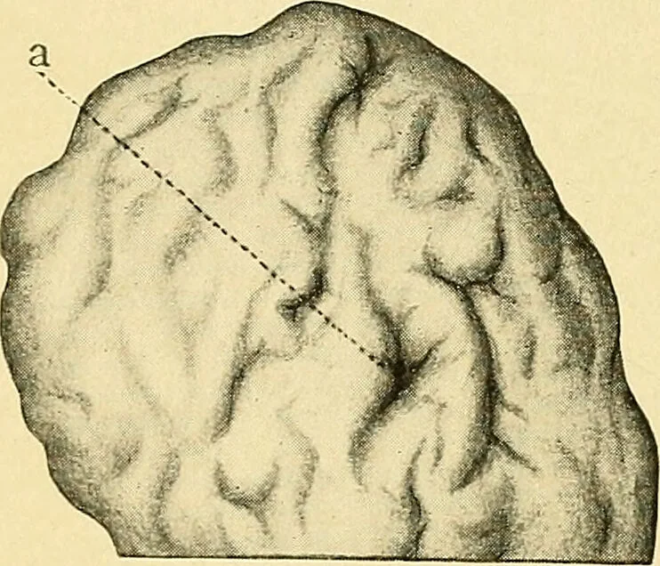 An illustration from A text-book of pathology for students of medicine / by J. George Adami and John McCrae ; illustrated with 304 engravings and 11 colored plates., 1912, leaf 640