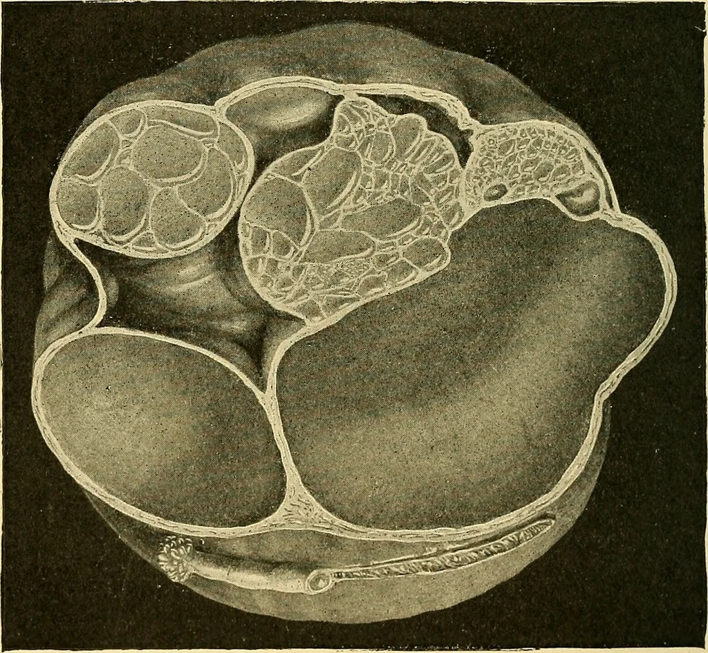 An illustration from A text-book of pathology for students of medicine / by J. George Adami and John McCrae ; illustrated with 304 engravings and 11 colored plates., 1912, leaf 682