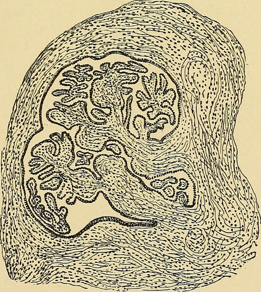 An illustration from A text-book of pathology for students of medicine / by J. George Adami and John McCrae ; illustrated with 304 engravings and 11 colored plates., 1912, leaf 693