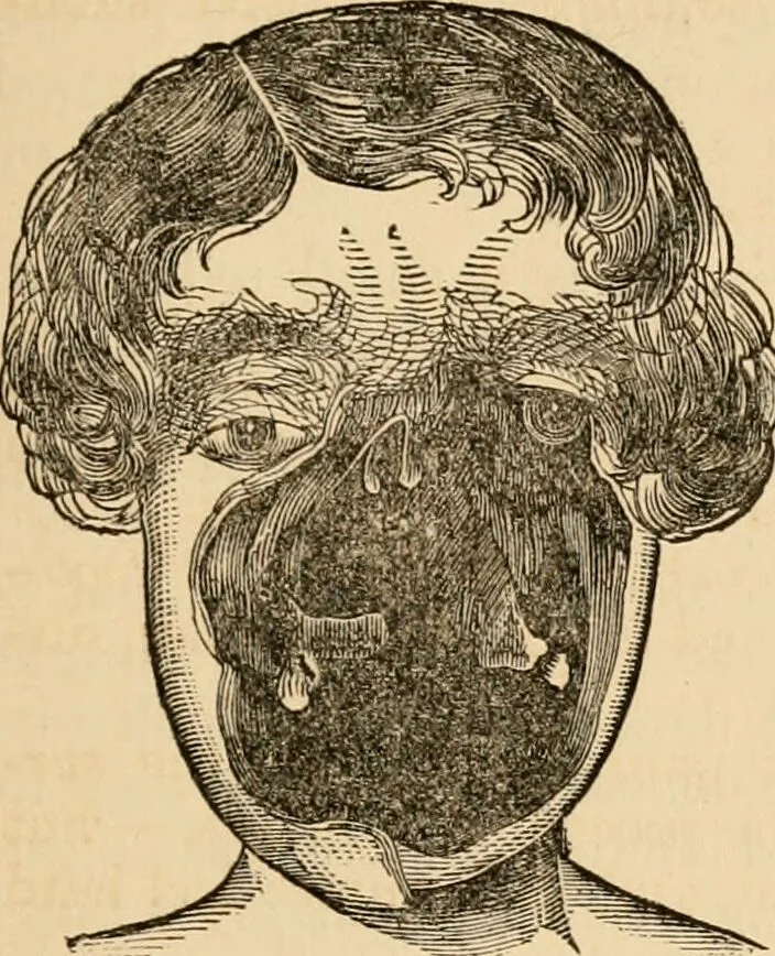 An illustration from The household physician : for the use of families, planters, seamen, and travellers ; being a brief description, in plain language, of all the diseases of men, women, and children, with the newest and most approved methods of curing them / by Ira Warren., 1866, leaf 161