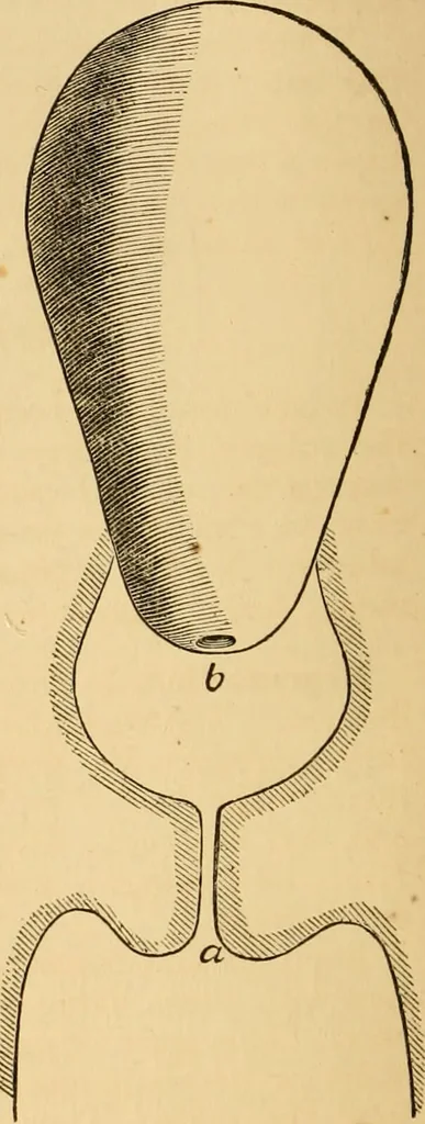 An illustration from The household physician : for the use of families, planters, seamen, and travellers ; being a brief description, in plain language, of all the diseases of men, women, and children, with the newest and most approved methods of curing them / by Ira Warren., 1866, leaf 396