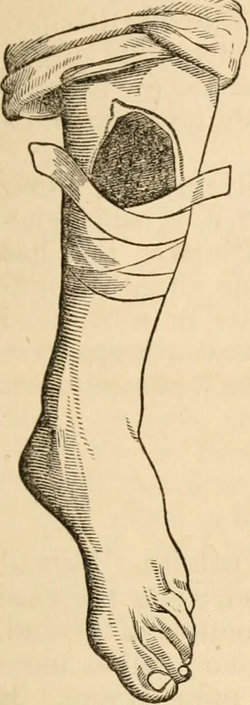 An illustration from The household physician : for the use of families, planters, seamen, and travellers ; being a brief description, in plain language, of all the diseases of men, women, and children, with the newest and most approved methods of curing them / by Ira Warren., 1866, leaf 459