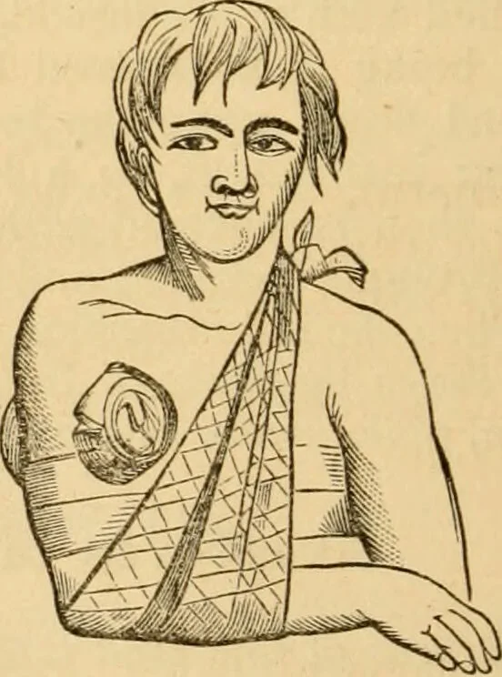 An illustration from The household physician : for the use of families, planters, seamen, and travellers ; being a brief description, in plain language, of all the diseases of men, women, and children, with the newest and most approved methods of curing them / by Ira Warren., 1866, leaf 474