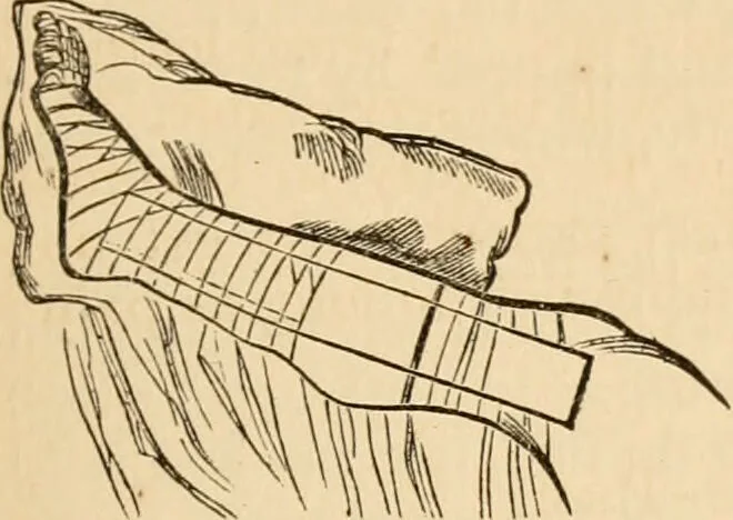 An illustration from The household physician : for the use of families, planters, seamen, and travellers ; being a brief description, in plain language, of all the diseases of men, women, and children, with the newest and most approved methods of curing them / by Ira Warren., 1866, leaf 481