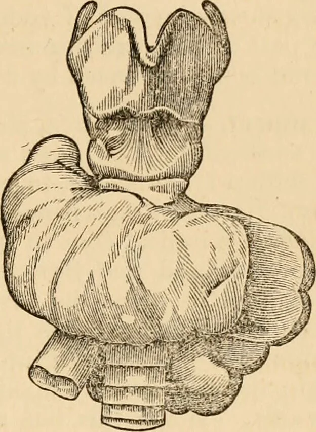 An illustration from The household physician : for the use of families, planters, seamen, and travellers ; being a brief description, in plain language, of all the diseases of men, women, and children, with the newest and most approved methods of curing them / by Ira Warren., 1866, leaf 499