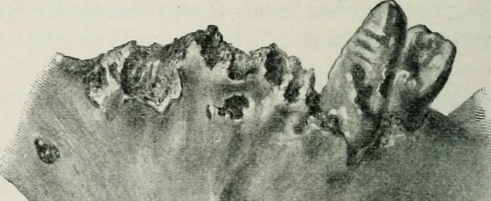 An illustration from Atlas and text-book of dentistry including diseases of the mouth / by Gustav Preiswerk. Edited by George W. Warren., 1906, leaf 174