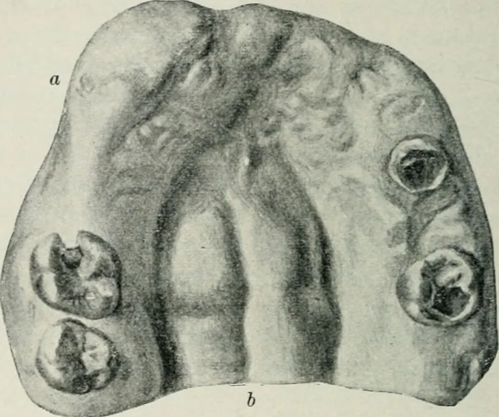 An illustration from Atlas and text-book of dentistry including diseases of the mouth / by Gustav Preiswerk. Edited by George W. Warren., 1906, leaf 194